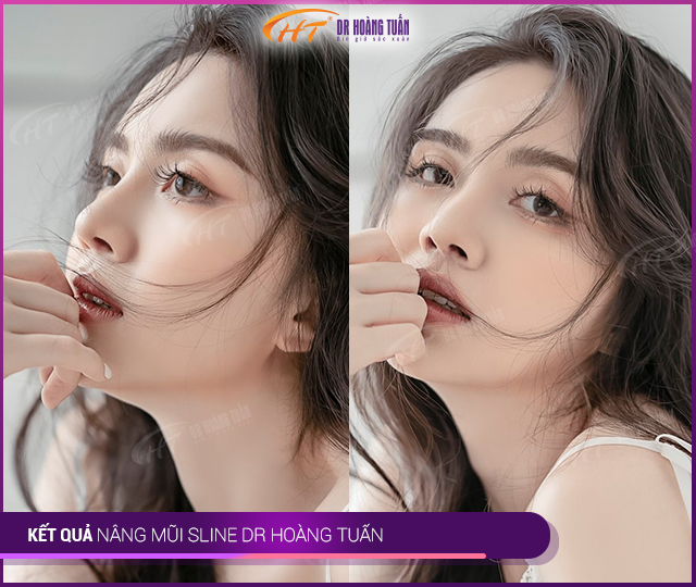 kết quả nâng mũi s line